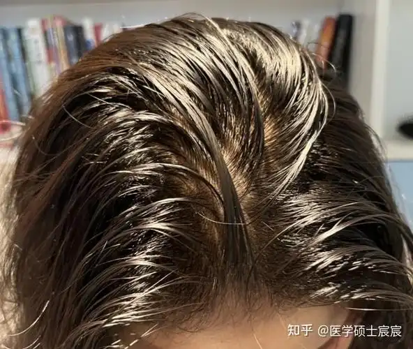 一,头发油腻,发丝粘成一绺一绺的?