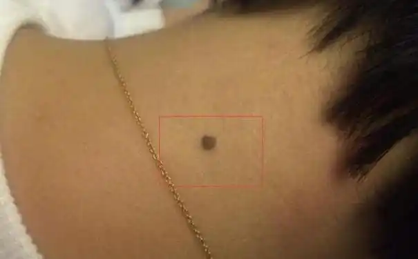 都说有苦情痣相的人头婚必定坎坷颇多甚至有二婚的可能