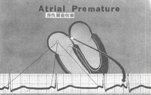 体征:心率>100次/分或 60次/分,心律不齐,大炮音等.