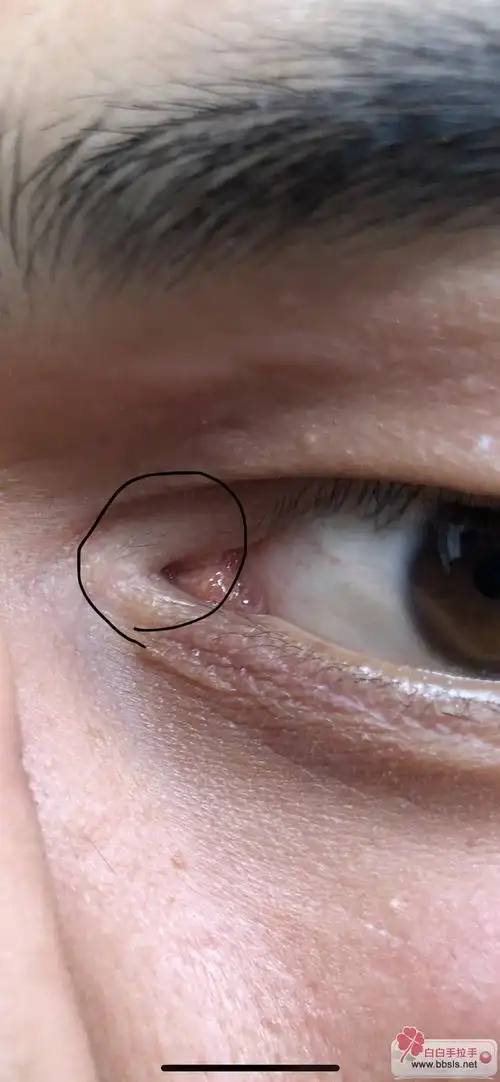内眼角伍德灯下发白,会是白癜风吗?
