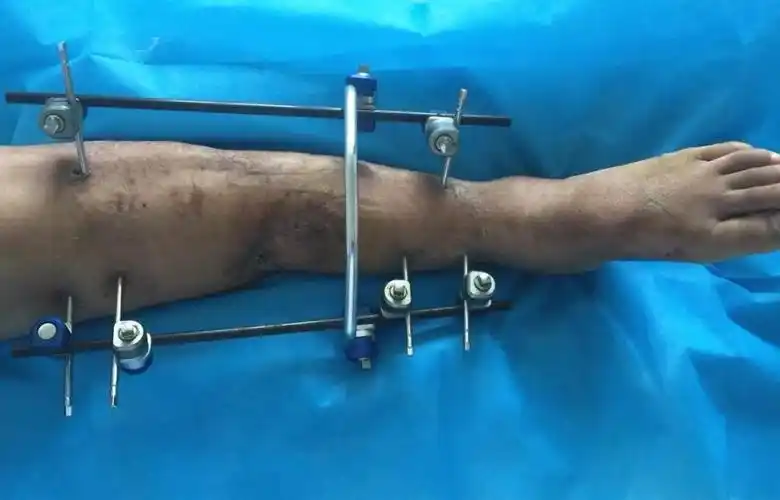 滑县一女3个月8次手术"双腿重生"!