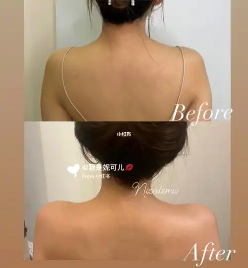 瘦肩肌肉斜方肌