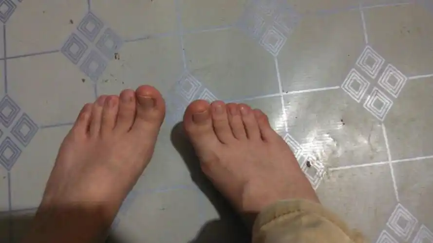 我的中脚趾有些弯曲,但不疼不影响跑步走路,可能是小时候出车祸造成的