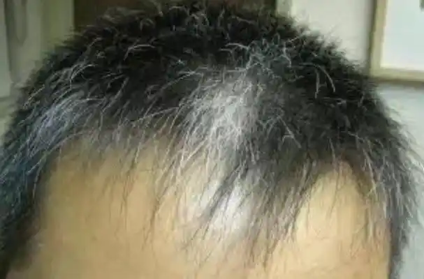 白发长在哪,病就从哪出?长在前额,两鬓,后脑勺,暗示着什么?