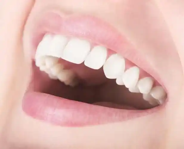 中医药方:上火牙疼,吃饭塞牙,牙齿酸软,牙齿松动,或轻松解决