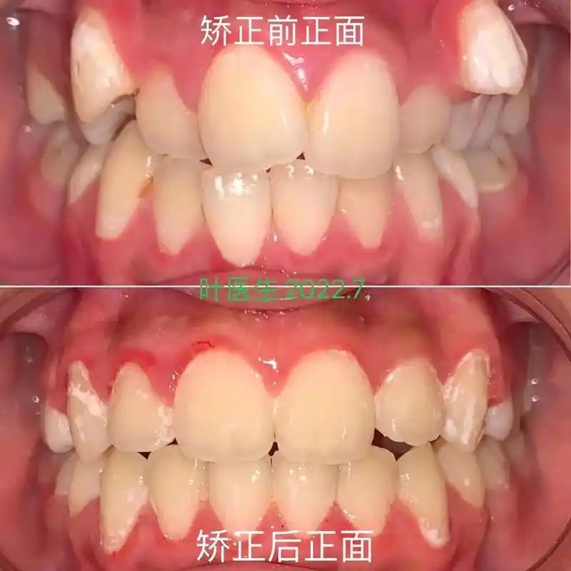 牙齿矫正.去年库存,来找我看牙这种虎牙翘起来的特别多,怎么解 - 抖音