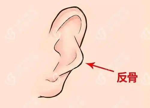反骨耳能做手术矫正吗耳朵反骨怎么改善方案给分享