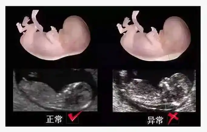 和普通b超有什么关系?怎么做可以通过?_胎儿_检测_畸形