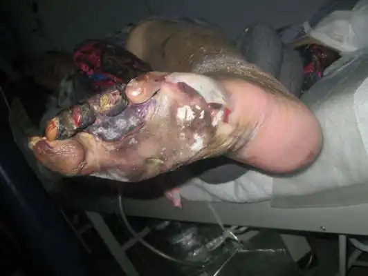 败血症图片 (84)