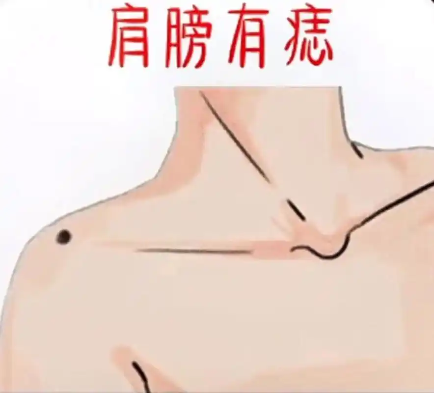 痣的含义(第三篇)-肩膀上的痣 肩膀上长痣代表什么含义?