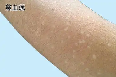 手上白斑最初期的图片