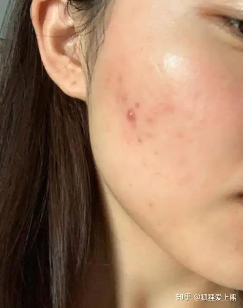 痘痘肌怎么办呀熬夜长痘姨妈长痘针清没用中药没用反反复复有没有同感