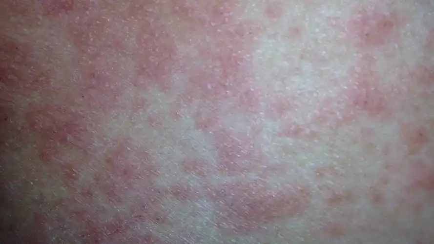 妊娠瘙痒性荨麻疹