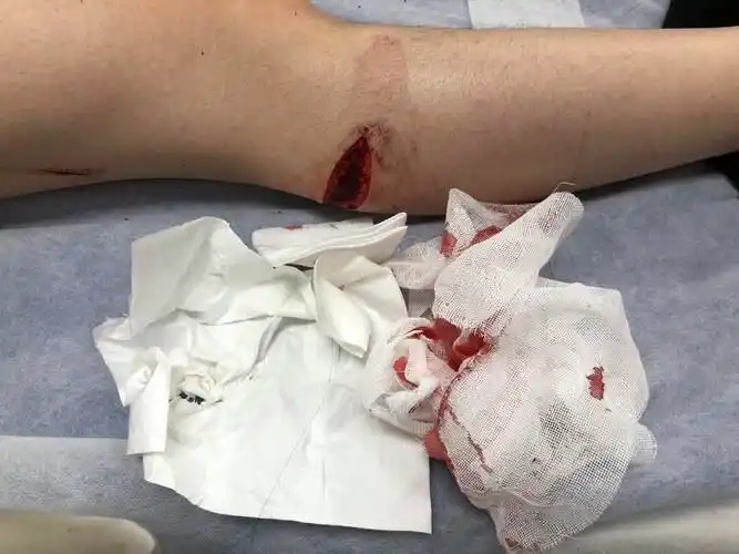 近三年的男友,因为吵架动手打我,还持刀把我砍伤.