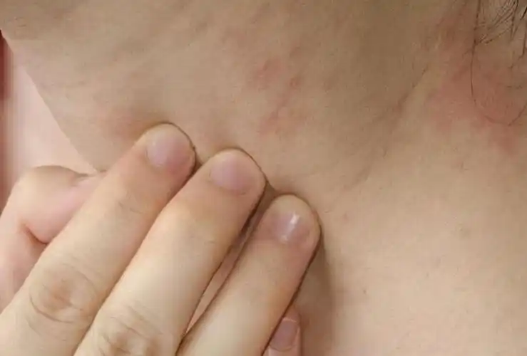 别把艾滋病当成皮肤病!