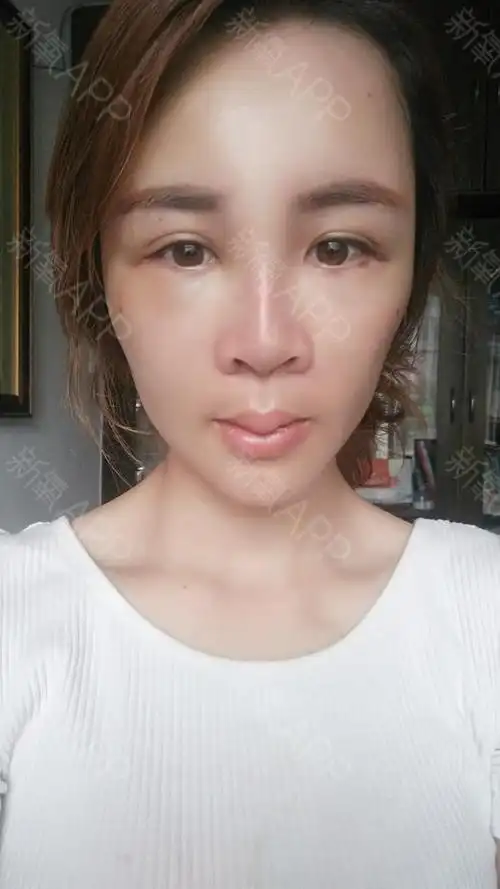 南宁自体脂肪全脸填充好不好_效果图_氧气b58ff5a20自体脂肪全脸填充