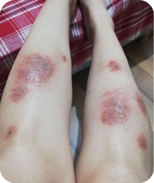 湿疹图片初期症状图片?看完图片后这些小妙招可以帮你赶走湿疹