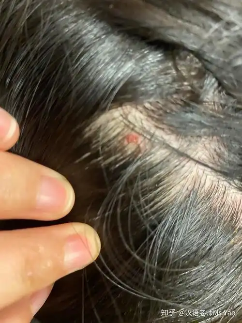 一直挠头头上有许多结痂怎么能不挠这是怎么回事而且挠完扣下结痂会有