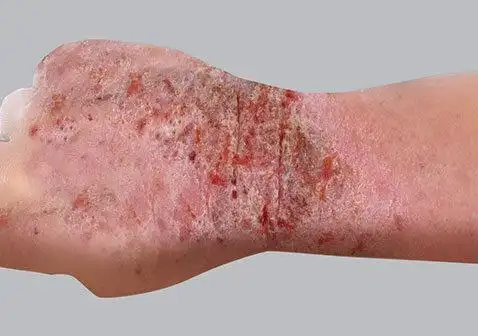 大人湿疹症状:丘疹大人湿疹症状:皮肤增厚或苔藓样变尽管存在其它类型