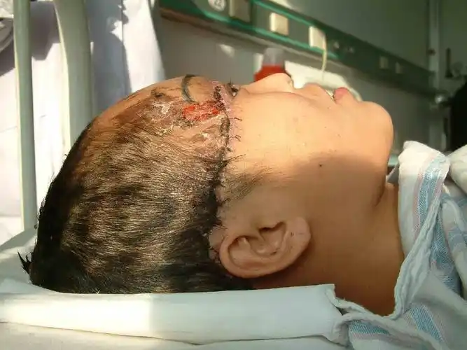 头皮撕脱伤可以再植_头皮撕脱伤_治疗方法_治疗方式 - 好大夫在线