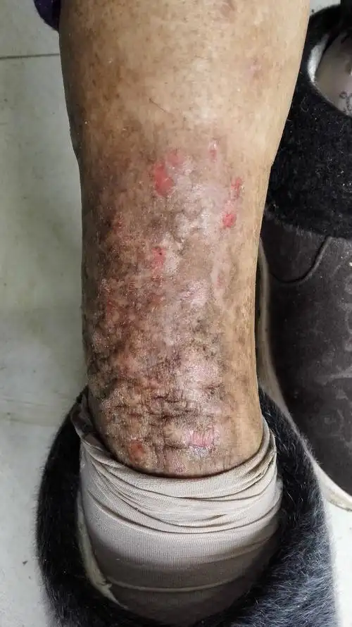 女性老年人皮肤瘙痒7年一直不好各位老师帮忙怎么治疗好一点