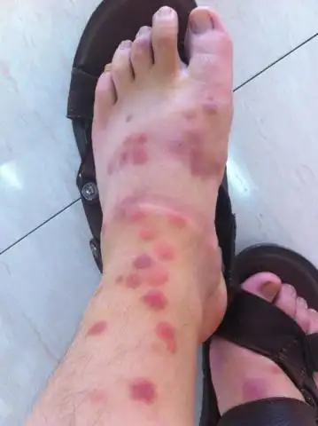 被跳蚤咬长了大红疙瘩了怎么办