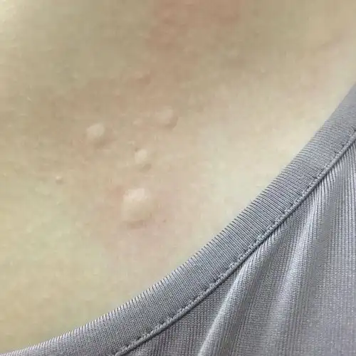 身上连着3天长了这种包,像是蚊子包一样,发红,会痒,一长就一大片,连着