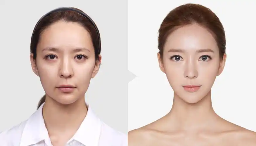 自体脂肪填充后全脸效果很假,后悔了不想要怎么解决