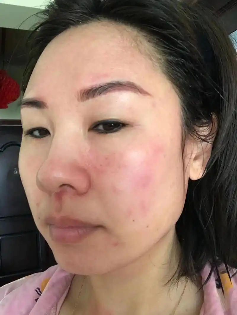我曾经也是一位敏感肌皮肤,一刺激皮肤就长痘 红 痒 干,经过 - 抖音