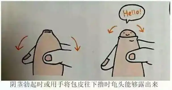 包茎,需要手术治疗了,手术切除的最佳年龄段是6-12周岁,建议青春期