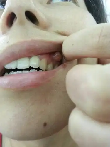 牙龈长个包包是怎么回事呢?去医院看了,医生说是上火!真的只是上火吗?