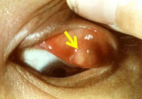 螺蛳粉~麻辣烫~吃多小心"上火"——麦粒肿详解_眼睑