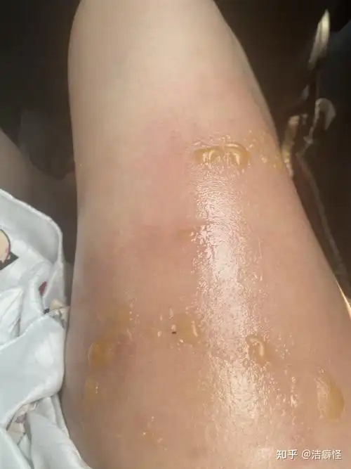 开水烫伤恢复过程更新中