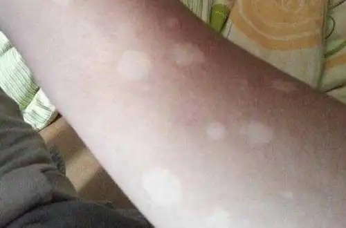 轻度白癜风早期症状图片