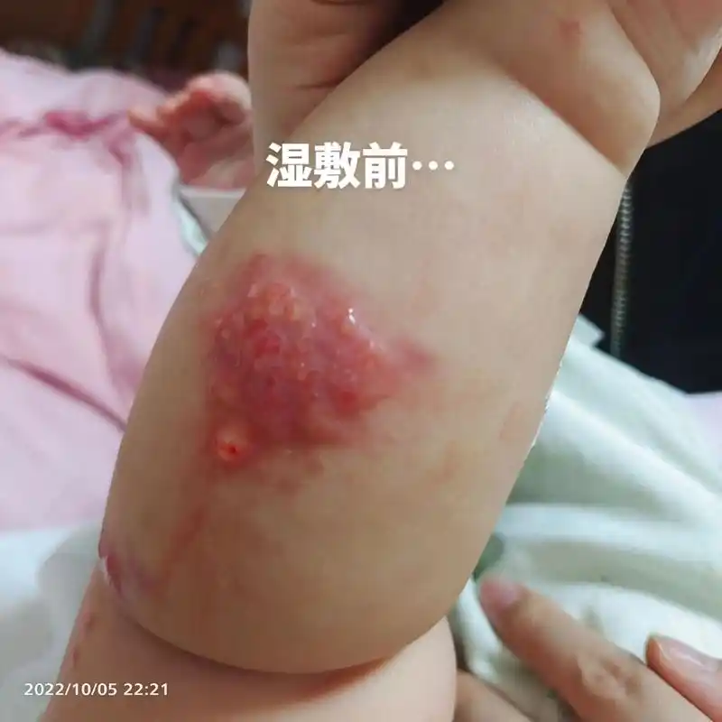 宝宝湿疹反复复发怎么办?渗出感染严重.