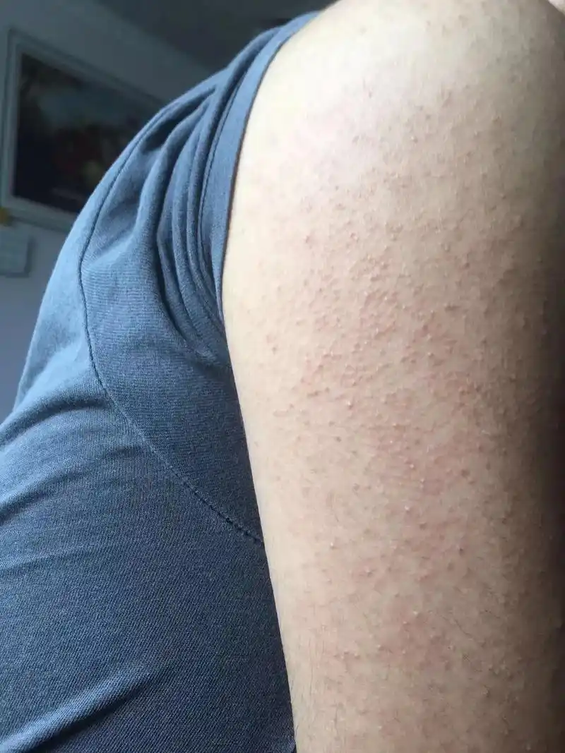 手臂鸡皮肤.使用10天,疙瘩有改善.因为疙瘩是密集的,顽固的 - 抖音