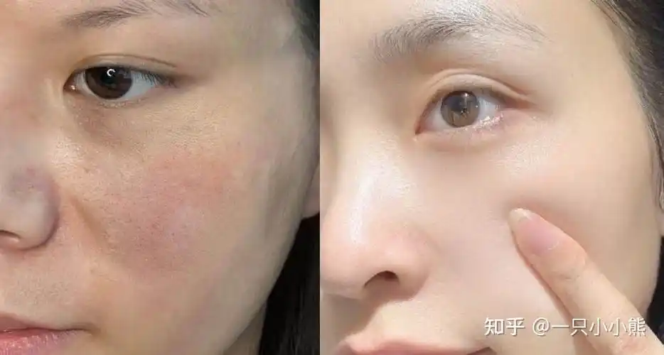 先看我皮肤的前后对比,有图有真相,这就是可信度!