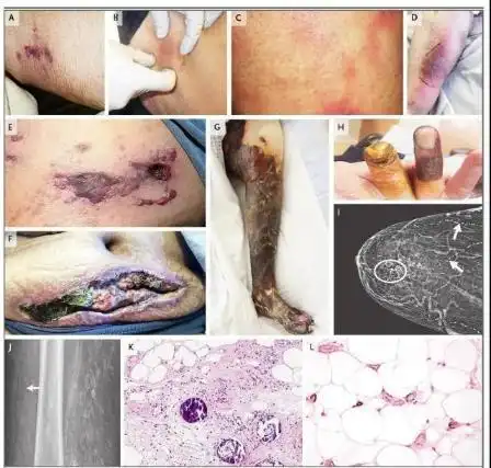 溃疡处的供血不足,就会导致皮肤坏死,坏疽,肢端脱落及败血症