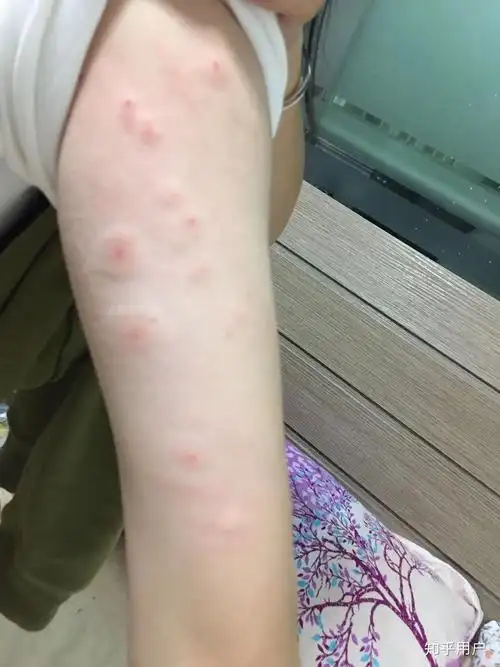 被跳蚤咬的全身都是包是什么样的感受! - 知乎