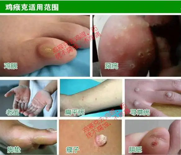 几滴碘酒化掉瘊子和鸡眼