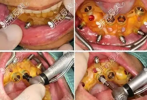3d导板做全口种植牙过程