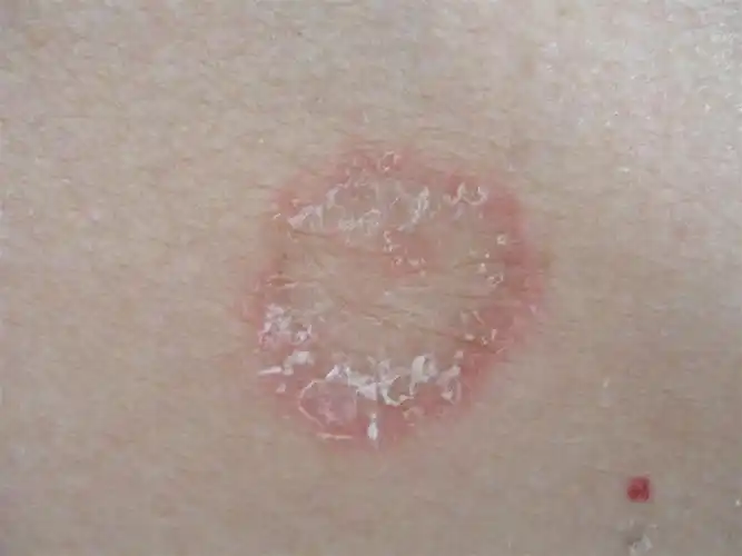 图示病例13 体癣