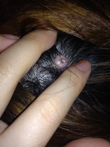 问:头皮上长了个小包 10几年了 大小基本上没变化 这是什么呀 用做掉