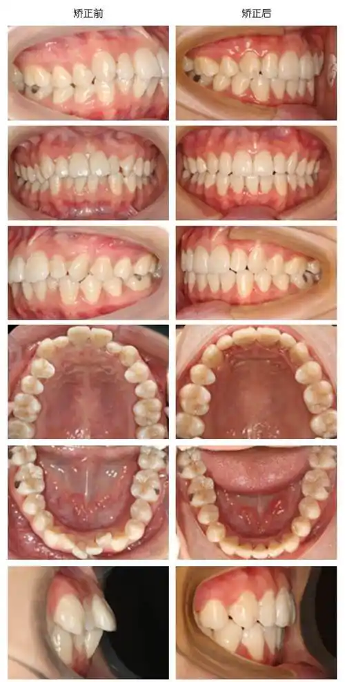 拥挤的牙齿越来越不齐?矫正迫在眉睫