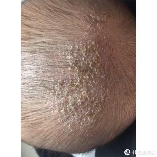 头皮屑通常由头皮干燥,脂溢性皮炎,真菌感染或皮肤炎症引起.