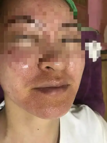 家住杭州余杭的沈女士,说起自己到美容院花大钱买修复霜给皮肤祛痘