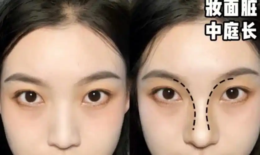 塌鼻梁颜值怎么弯道超车