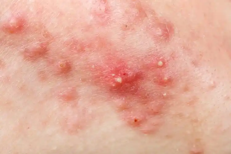 背部毛周角化毛囊炎图片_有来医生