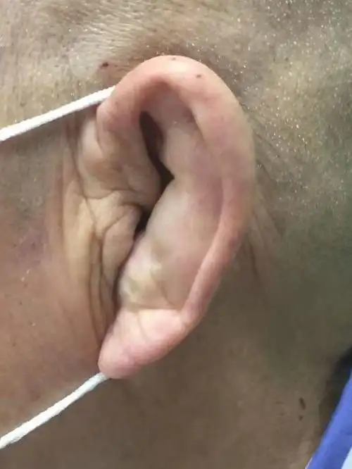 中老年人养生千万要当心|囊肿|外伤|手术|耳廓_网易订阅