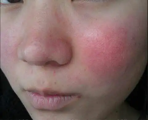 如何修复红血丝皮肤!太多家人护肤产品使用不当,后天形成红血丝!